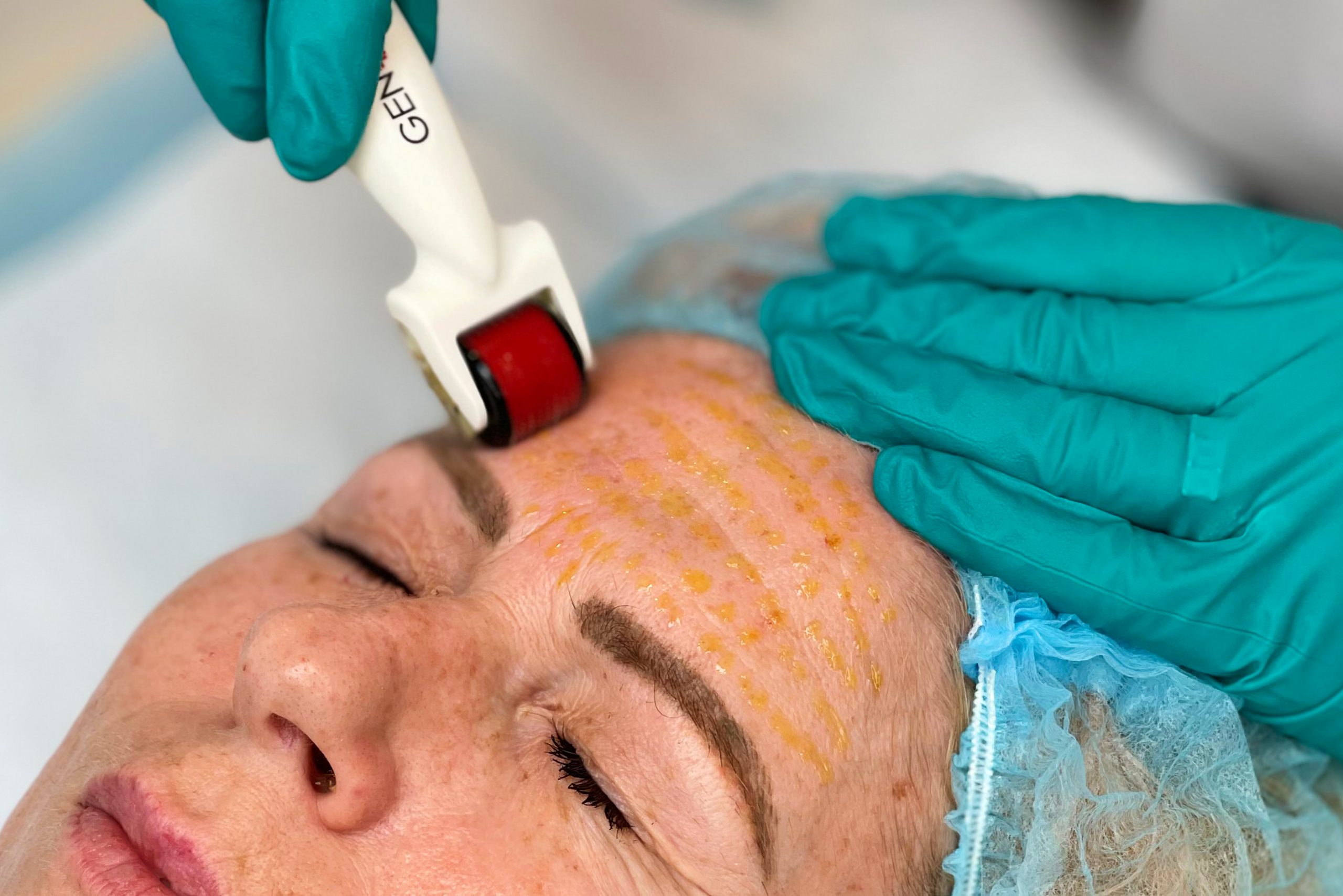 MicroNeedling Natural Enhancement Clinic